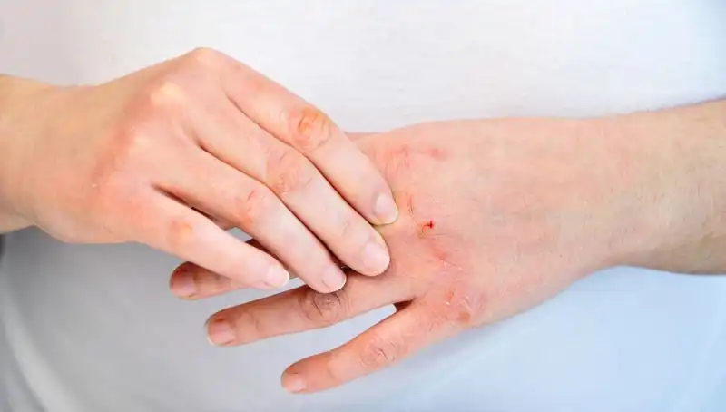 Yetersiz Protein Tüketimi Belirtileri: 6 İşaret Üzerine Düşünün